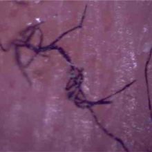 The Link Between GMOs And Morgellons Disease
